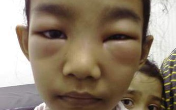 V&#236; sao mắc chứng thận hư?