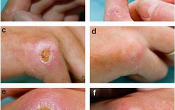 Bạn biết g&#236; về bệnh xơ cứng b&#236; to&#224;n thể?