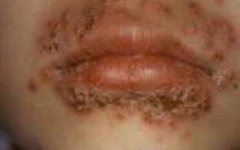 Thuốc chữa herpes m&#244;i