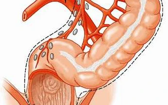 Thuốc điều trị vi&#234;m lo&#233;t đại trực tr&#224;ng chảy m&#225;u