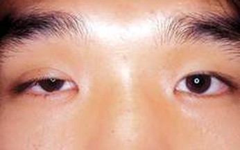 Sụp mi mắt, bệnh th&#224;nh dị tật