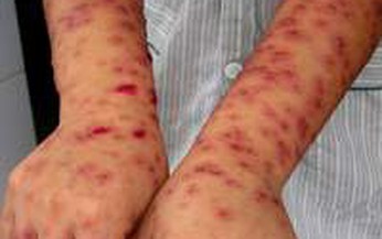 Chớ coi thường mụn nước