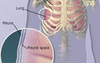 Bạn biết g&#236; về tr&#224;n dịch m&#224;ng phổi thanh tơ?