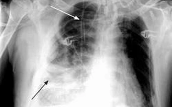 Nguy cơ do viêm mủ màng phổi