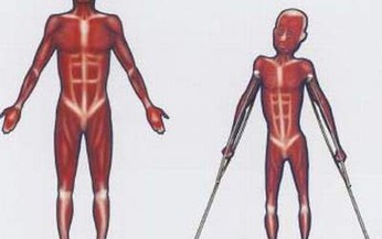 Triển vọng ứng dụng liệu ph&#225;p gen điều trị bệnh loạn dưỡng cơ Duchenne