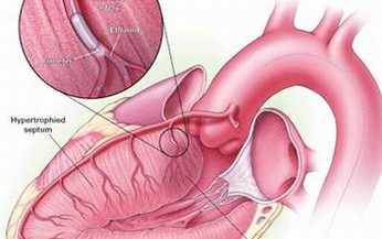 Phương ph&#225;p m&#224;u nhiệm xử tr&#237; bệnh cơ tim ph&#236; đại