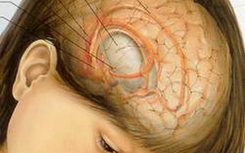 Dị tật bẩm sinh đi đ&#244;i với c&#225;c khối u n&#227;o ở trẻ em