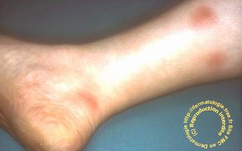 Hồng ban rắn Bazin dễ nhầm với nhiều bệnh kh&#225;c