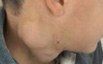 Chế phẩm mới điều trị u Lympho
