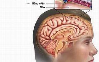  Nhận biết vi&#234;m m&#224;ng n&#227;o do n&#227;o m&#244; cầu