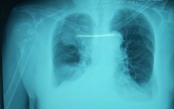 Tr&#224;n dịch m&#224;ng phổi v&#236;… mắc xương c&#225;