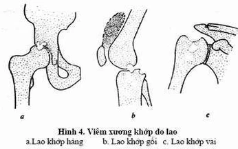 &#208;ừng để t&#224;n phế v&#236; lao xương khớp