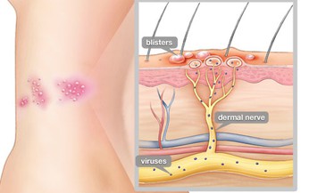 B&#224;i thuốc chữa bệnh zona