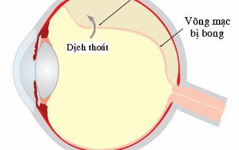 Ph&#225;t hiện sớm nguy cơ bong v&#245;ng mạc g&#226;y m&#249;