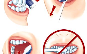 Điều trị m&#242;n răng kh&#243; hay dễ?