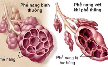 Bệnh kh&#237; phế thũng  c&#243; nguy hiểm?