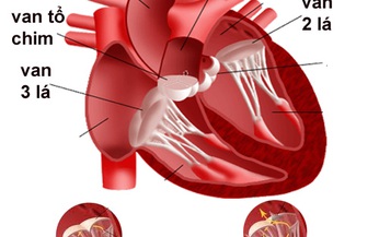 Ph&#242;ng bệnh van hai l&#225; do thấp