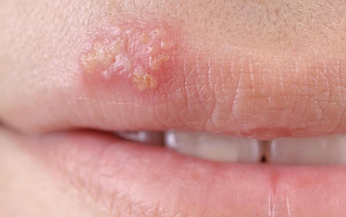 Bệnh do virut Herpes, d&#249;ng thuốc g&#236;?