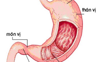 Vi&#234;m hang vị sung huy&#234;́t c&#243; nguy hiểm?