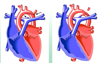 Hẹp eo động mạch chủ: M&#244;̣t dị tật dễ bị bỏ s&#243;t