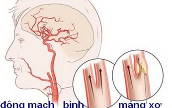 Hẹp động mạch cảnh - Một nguy&#234;n nh&#226;n g&#226;y tai biến mạch m&#225;u n&#227;o