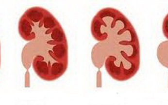 Hẹp phần nối bể thận niệu quản c&#243; nguy hiểm?