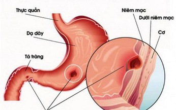 Dược thiện cho người vi&#234;m lo&#233;t dạ d&#224;y t&#225; tr&#224;ng