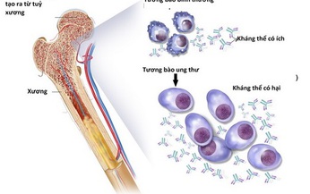 Liệu ph&#225;p mới điều trị đa u tủy xương