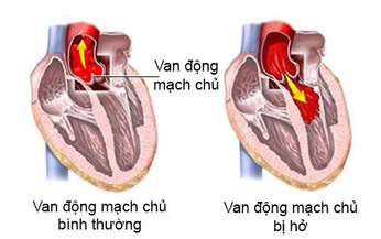 Hở động mạch chủ c&#243; nguy hiểm?