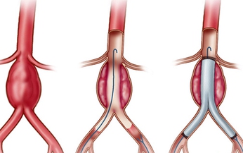 Phương ph&#225;p can thiệp động mạch chủ: “Cứu tinh” của người bị ph&#236;nh t&#225;ch động mạch chủ