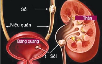 B&#224;i thuốc điều trị sỏi tiết niệu