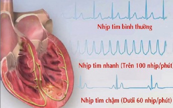 B&#224;i thuốc chữa trị nhịp tim chậm