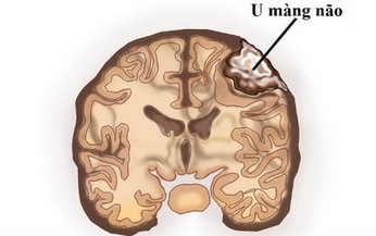 Nguy cơ u m&#224;ng n&#227;o khi d&#249;ng thuốc nội tiết cyproteron