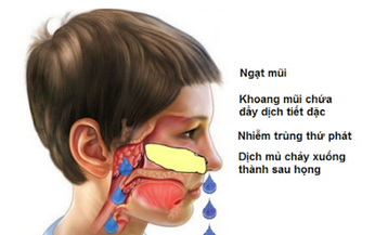 Vi&#234;m VA ở trẻ khi n&#224;o nguy hiểm?