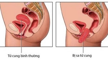 Bệnh sa sinh dục: Những điều cần biết