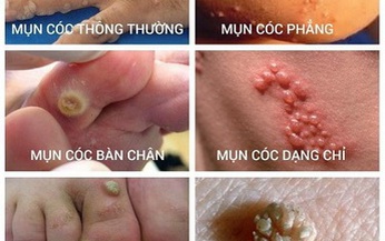 Mụn c&#243;c: Điều trị sớm để tr&#225;nh l&#226;y lan