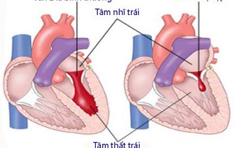 Dấu hiệu bệnh van hai l&#225; do thấp