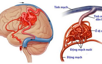 Dị dạng mạch n&#227;o: Bệnh nguy hiểm, dễ nhầm lẫn