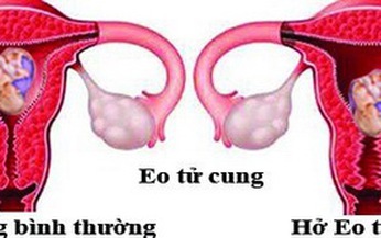 Bệnh dễ g&#226;y sẩy thai &#237;t người biết