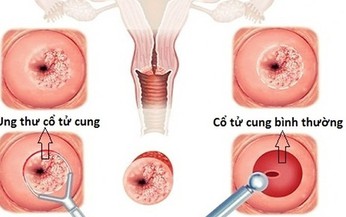 Ph&#225;t hiện sớm ung thư cổ tử cung