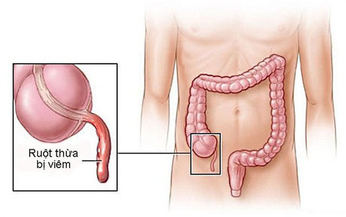 Vi&#234;m ruột thừa, v&#236; sao cần phẫu thuật ngay?