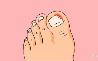 Móng quặp, chữa trị thế nào?