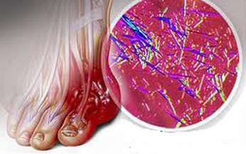 Tăng acid uric m&#225;u, kh&#244;ng chỉ lo bị g&#250;t