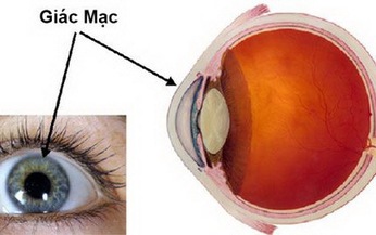 Vi&#234;m lo&#233;t gi&#225;c mạc, tr&#225;nh thế n&#224;o?