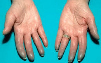 Thuốc điều trị hội chứng Raynaud