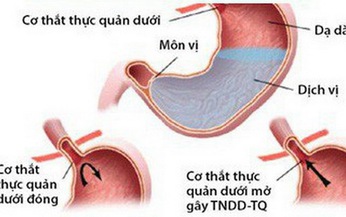 Co thắt thực quản c&#243; chữa được kh&#244;ng?