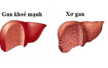 Xơ gan do rượu nguy hiểm thế n&#224;o?