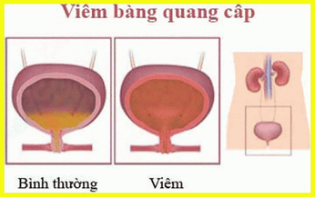 Vi&#234;m b&#224;ng quang cấp: Để l&#226;u dễ g&#226;y suy thận