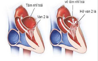 B&#224;i thuốc ph&#242;ng trị thấp tim