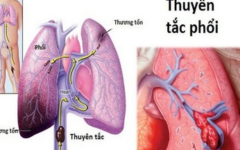 Nhận biết sớm huyết khối tĩnh mạch s&#226;u